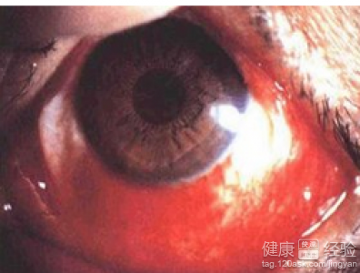 紅眼病多發於年輕人5大手段助您遠離紅眼病