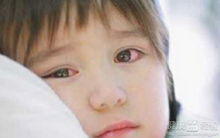 依賴電腦當心惹上紅眼病引起孩子紅眼病的原因