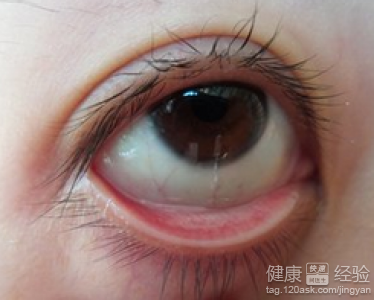 夏天謹防感染紅眼病紅眼病如何做好保健工作？