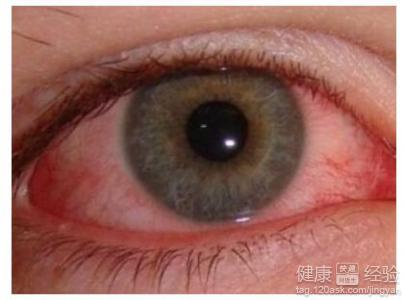 怎樣預防紅眼病？教你如何正確預防紅眼病