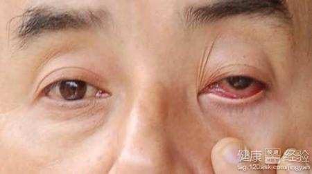紅眼病長期不治危害大如何徹底治好它