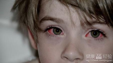紅眼病用什麼藥治療？紅眼病用藥原則