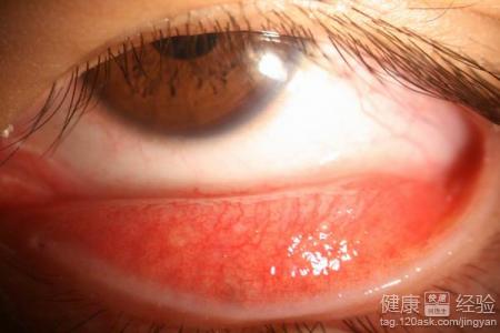 紅眼病不宜用眼藥膏結膜炎的治療方法