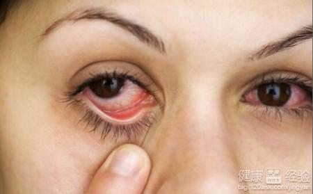 紅眼病的護理方法有哪些