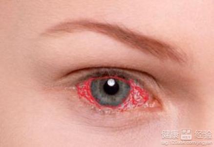紅眼病和過敏性結膜炎有什麼區別？