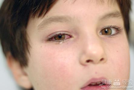 紅眼病易傳染中醫中藥有辦法