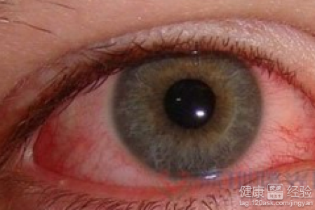 紅眼病如何治療？防治紅眼病有妙招