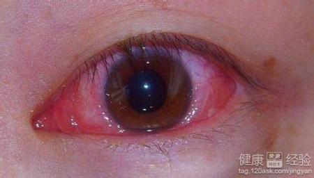 紅眼病人不宜塗眼膏紅眼病保健