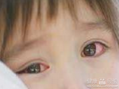 寶寶患上紅眼病四個方面護理