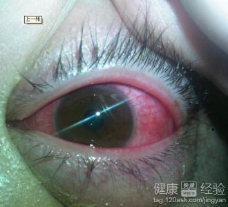 紅眼病認識和防治的3大誤區
