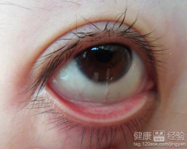 兩種被忽略的紅眼病傳播途徑