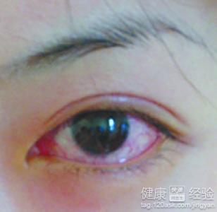 紅眼病的預防常識及注意事項