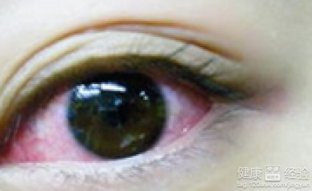 炎夏預防紅眼病要做到三步