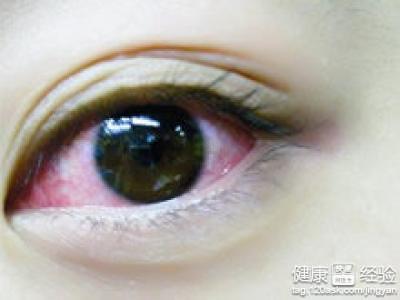 預防紅眼病的注意事項