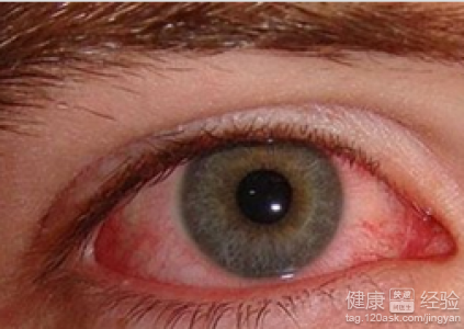 紅眼病的症狀與預防方法