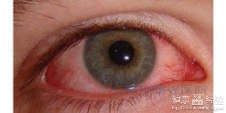 治療紅眼病民間辦法