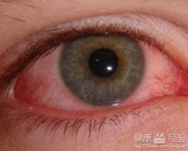 紅眼病怎麼防治
