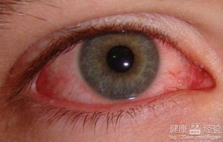 紅眼病不治可以自愈嗎