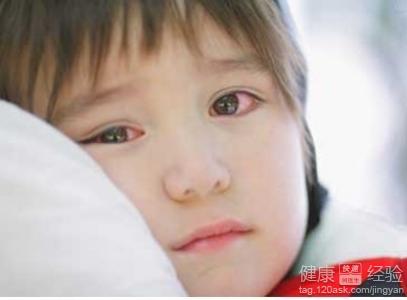 幼兒紅眼病預防知識