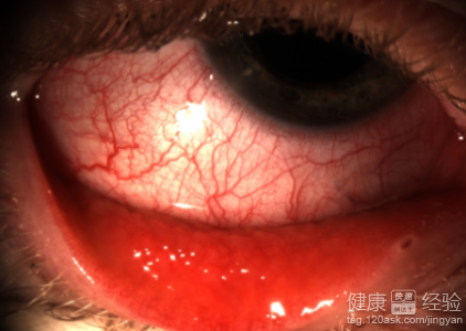 角膜炎與紅眼病