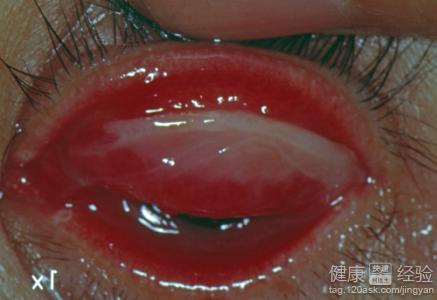 虹膜炎是紅眼病嗎