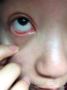 紅眼病症狀有哪些