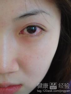 如何預防紅眼病傳染