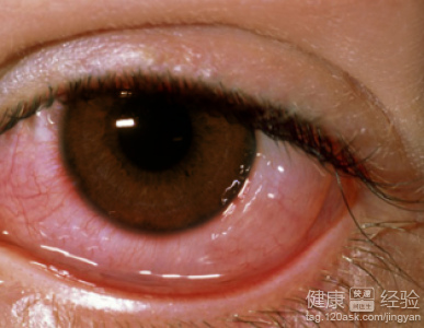紅眼病復發怎麼辦