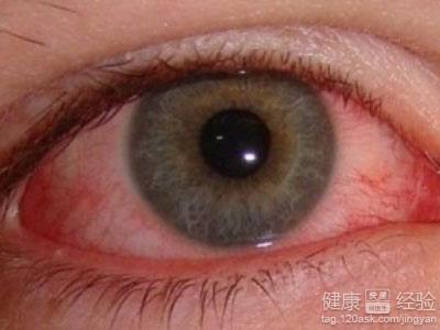 紅眼病隔離期為幾天