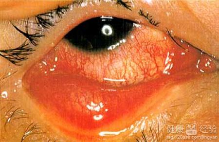 紅眼病會復發嗎