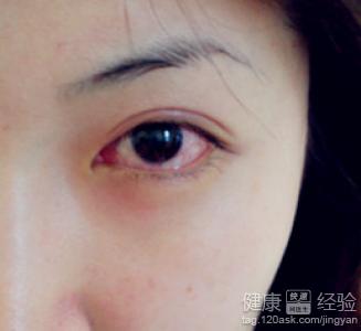 紅眼病會影響視力嗎