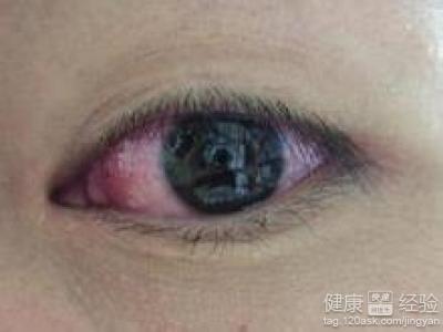 如何預防和治療紅眼病