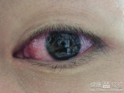 紅眼病初期如何護理
