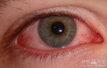 紅眼病有什麼預兆啊