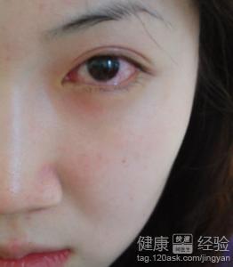 怎樣才能更快更好的治療紅眼病
