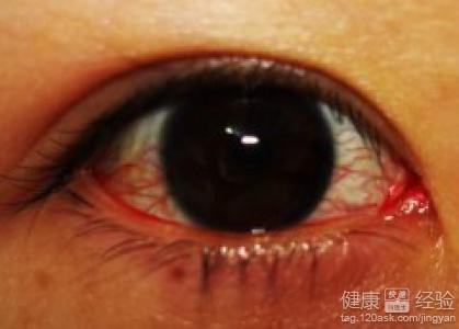 紅眼病的有效治療有哪些