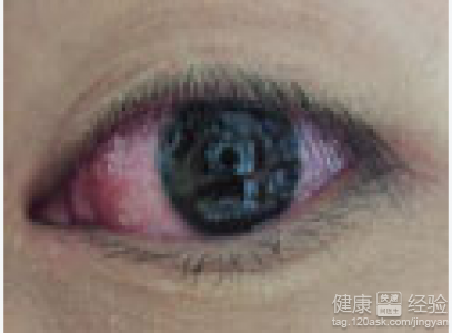 紅眼病是通過什麼途徑傳染的