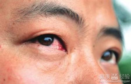 眼睛發紅、癢，是否是紅眼病、結膜炎