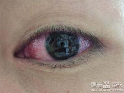 什麼是紅眼病潛伏期