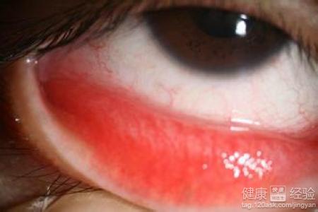 紅眼病治愈後結膜還是有點發紅怎麼辦