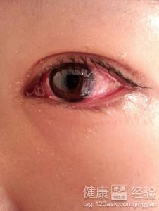 急性結膜炎導致的紅眼病該怎麼辦