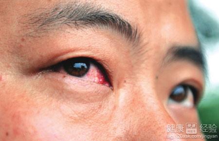 紅眼病症狀都有老刺疼怎麼辦