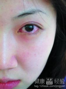哺乳期的婦女得了紅眼病怎麼治療
