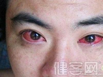 紅眼病怎麼治療比較快和好