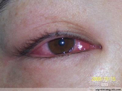 現在紅眼病最有效的療法是什麼