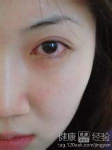 紅眼病治愈方法