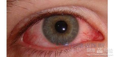 紅眼病是什麼通過哪些途徑傳染