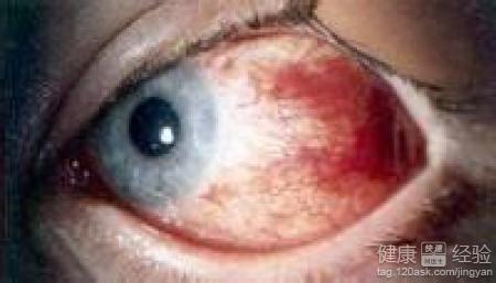 在紅眼病高發季節該怎麼做