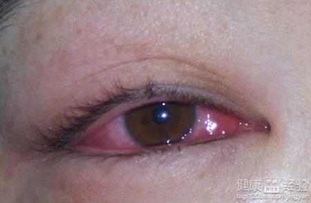 預防紅眼病的幾個注意事項