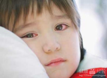 小孩子患有紅眼病以後注意些什麼